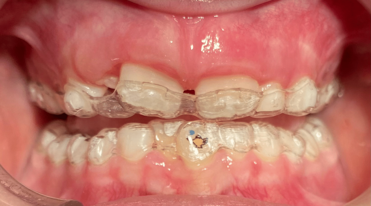 Children’s Braces - Hampshire Dentists Pain Free Dentist in Southampton Invisalign First aligners in mouth showing Invisalign Stickable