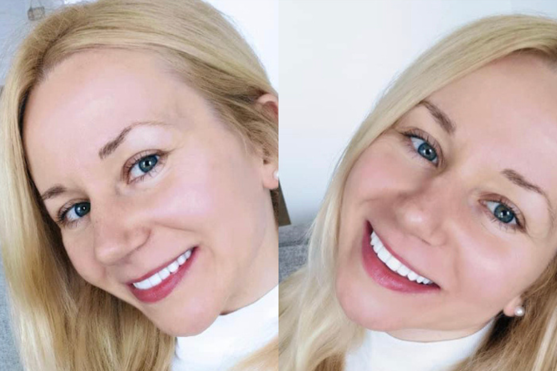 Photos taken by patient smiling confidently to showcase her composite bonding treatment at Hampshire Dentists