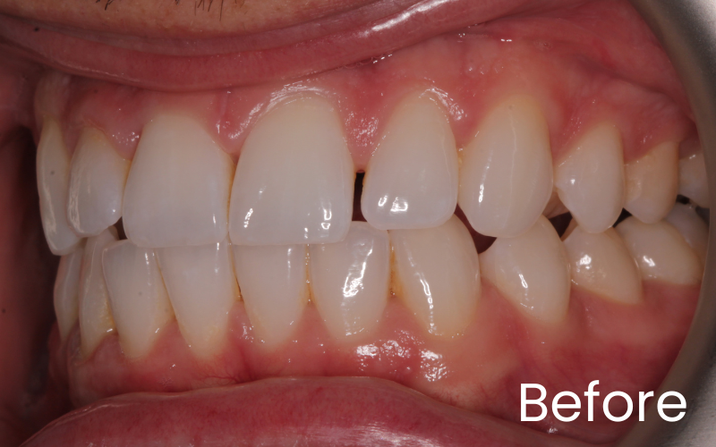 Composite bonding - Hampshire Dentists Pain Free Dentist in Southampton