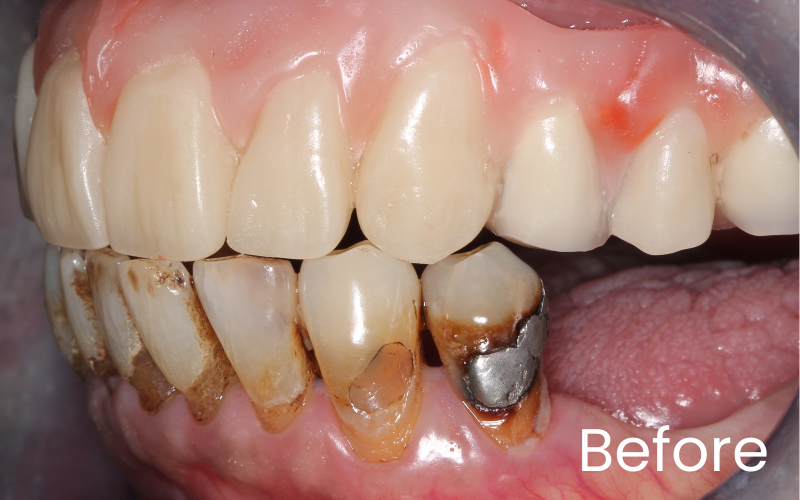 Left retracted view of teeth before dental implant treatment showing missing back left teeth