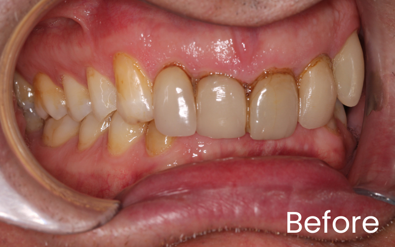 Dental Veneers - Hampshire Dentists Pain Free Dentist in Southampton Dental Veneers - Hampshire Dentists Pain Free Dentist in Southampton