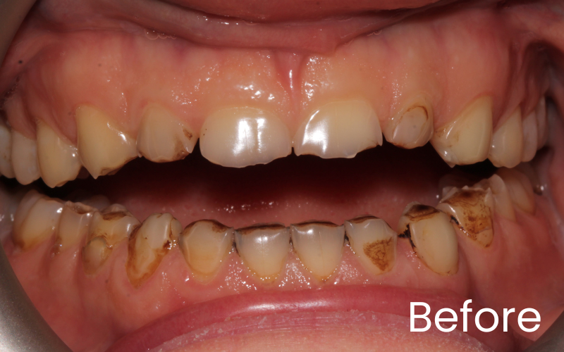 Front full image of teeth with significant tooth wear before smile makeover with dental crown treatment
