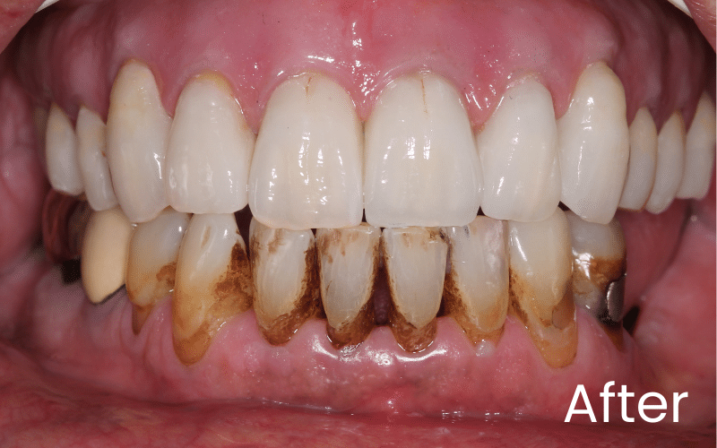 Full mouth implants (All on 4) - Hampshire Dentists Pain Free Dentist in Southampton Full front retracted view of showing full teeth replacement with dental implants, all on 4