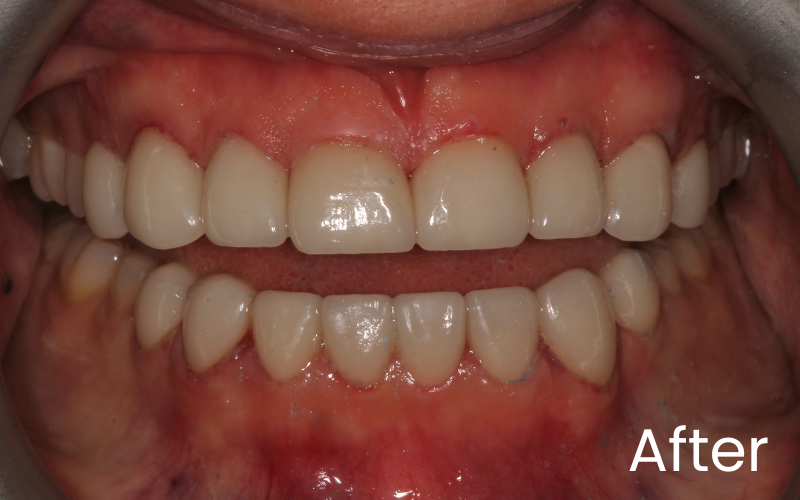 Front full image of teeth after smile makeover with dental crown treatment