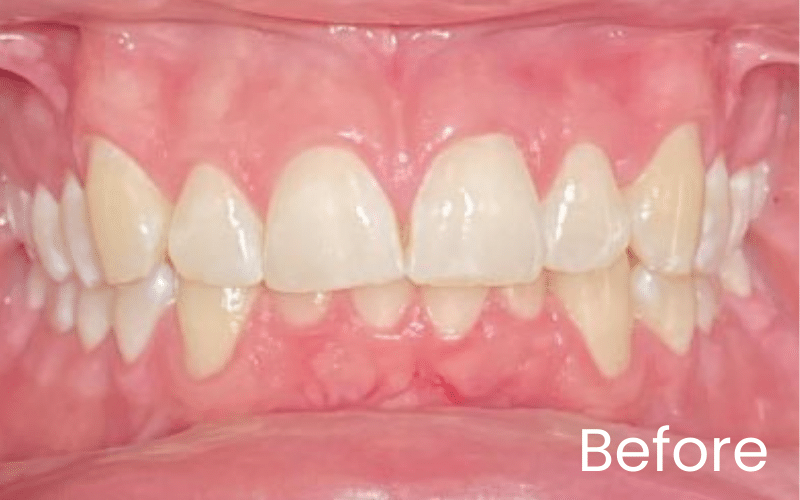 Straight Teeth Options - Hampshire Dentists Pain Free Dentist in Southampton Straight Teeth Options - Hampshire Dentists Pain Free Dentist in Southampton