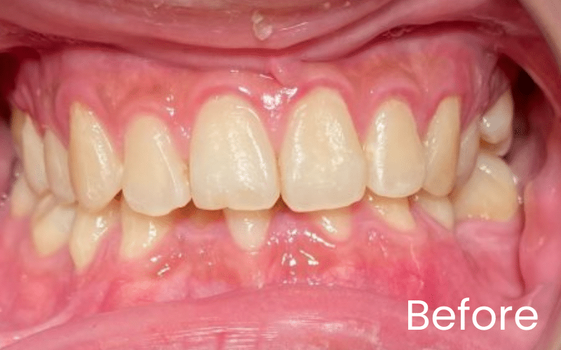 Fixed braces - Hampshire Dentists Pain Free Dentist in Southampton Fixed braces - Hampshire Dentists Pain Free Dentist in Southampton
