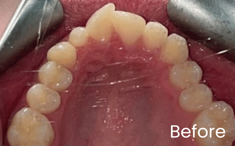 Children’s Braces - Hampshire Dentists Pain Free Dentist in Southampton Children’s Braces - Hampshire Dentists Pain Free Dentist in Southampton