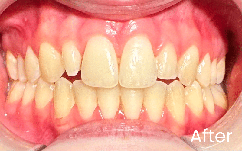 Children’s Braces - Hampshire Dentists Pain Free Dentist in Southampton Front full retracted image of teeth after teeth straightening with Invisalign for teenagers in Southampton