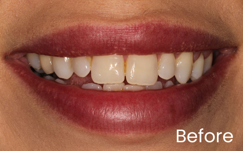Composite bonding - Hampshire Dentists Pain Free Dentist in Southampton