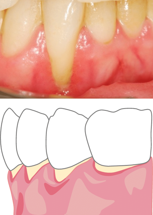 Gum Contouring - Hampshire Dentists Pain Free Dentist in Southampton Image and supporting graphic representation of gum recession