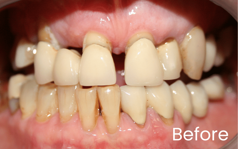 Dental Implants - Hampshire Dentists Pain Free Dentist in Southampton Front full image of teeth before dental implant treatment