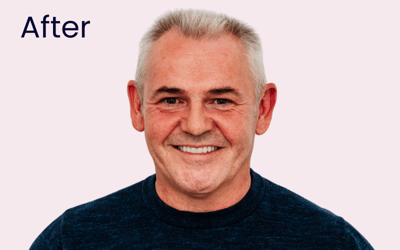 Dental Implants - Hampshire Dentists Pain Free Dentist in Southampton Image of patient after dental implant treatment
