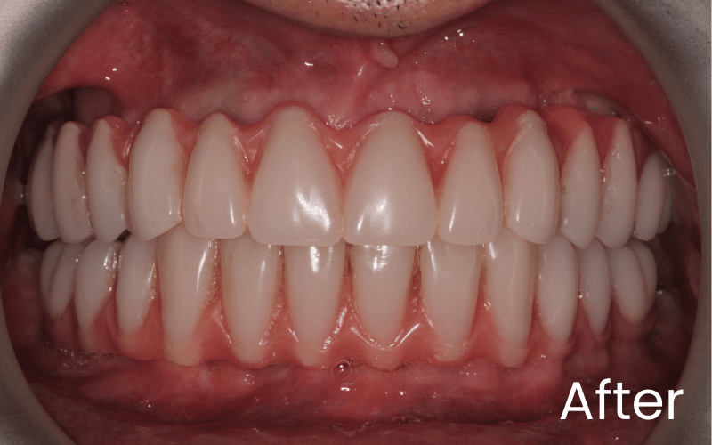 Dental Implants - Hampshire Dentists Pain Free Dentist in Southampton Front full image of teeth after dental implant treatment