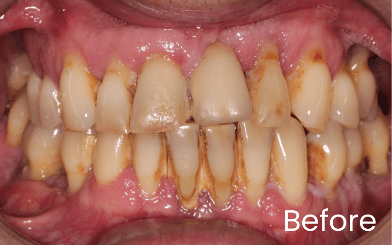 Dental Implants - Hampshire Dentists Pain Free Dentist in Southampton Front full image of teeth before dental implant treatment