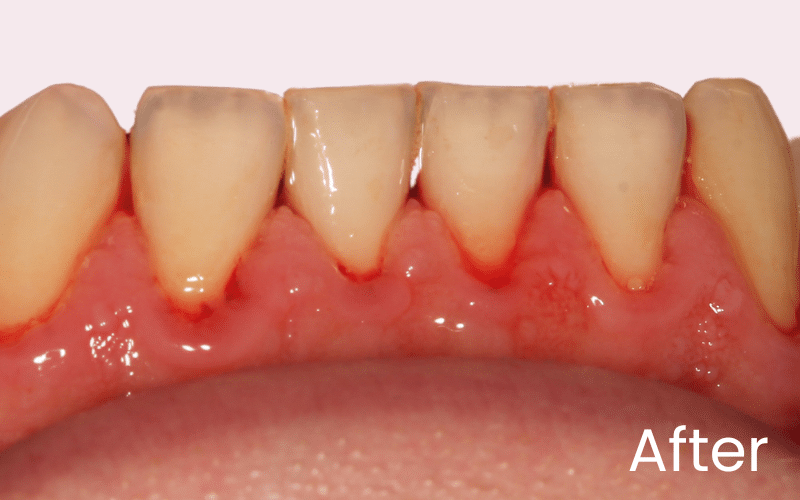 Hygienist - Hampshire Dentists Pain Free Dentist in Southampton Image of lower teeth after hygiene/ gum treatment