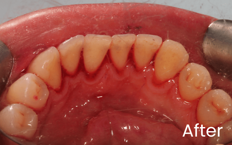 Hygienist - Hampshire Dentists Pain Free Dentist in Southampton Image of lower teeth from the tongue side after hygiene/ gum treatment