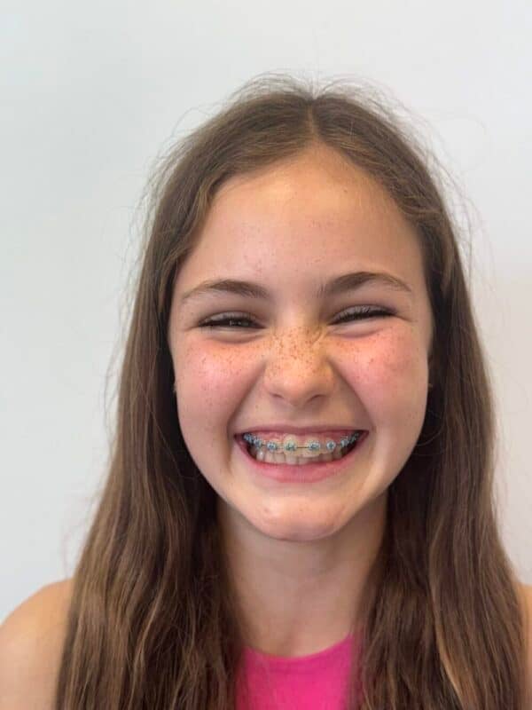 Children’s Braces - Hampshire Dentists Pain Free Dentist in Southampton Smiling child with braces at Hampshire Dentists in Southampton