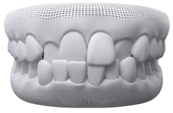 Children’s Braces - Hampshire Dentists Pain Free Dentist in Southampton A 3D model of teeth illustrating an example of teeth showcasing an crossbite condition.