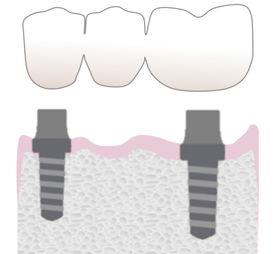 Graphic representing multiple teeth implants 