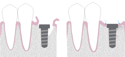 Graphic showing stages of guided bone regeneration