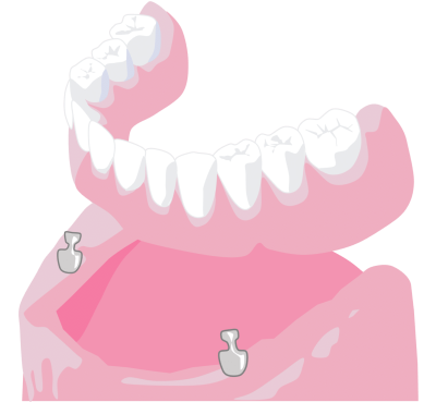 Implant stabilised dentures - Hampshire Dentists Pain Free Dentist in Southampton Graphic representation of implant stabilised denture for lower teeth