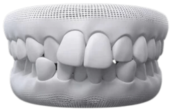 Children’s Braces - Hampshire Dentists Pain Free Dentist in Southampton A 3D model of teeth illustrating an example of teeth showcasing an dental crowding condition.