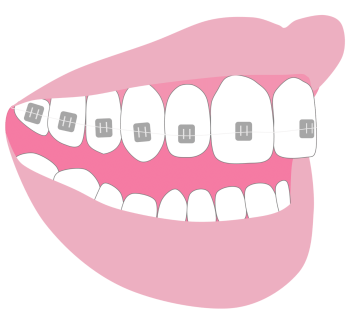 Fixed braces - Hampshire Dentists Pain Free Dentist in Southampton Graphic representation of metal fixed braces on teeth