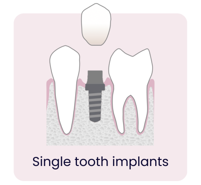 Dental Implants - Hampshire Dentists Pain Free Dentist in Southampton Graphic representation of single tooth implant