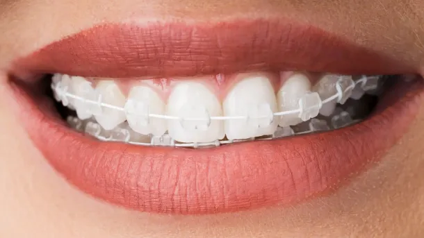 Essential insights: what you need to know about Dental Implants on the NHS - Hampshire Dentists Pain Free Dentist in Southampton