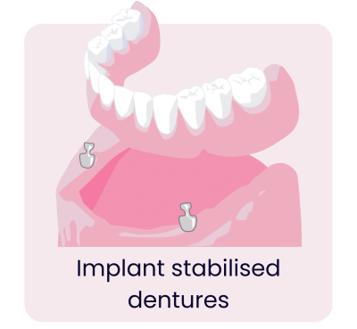 Dental Implants - Hampshire Dentists Pain Free Dentist in Southampton Graphic representation of implant stabilised denture