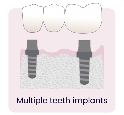 Dental Implants - Hampshire Dentists Pain Free Dentist in Southampton Graphic representation of multiple teeth implant bridges