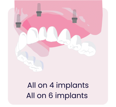 Dental Implants - Hampshire Dentists Pain Free Dentist in Southampton Graphic representation of full mouth implant retained bridge