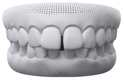 Children’s Braces - Hampshire Dentists Pain Free Dentist in Southampton A 3D model of teeth illustrating an example of teeth showcasing an dental spacing condition.