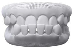 Children’s Braces - Hampshire Dentists Pain Free Dentist in Southampton A 3D model of teeth illustrating an example of teeth showcasing an underbite condition.