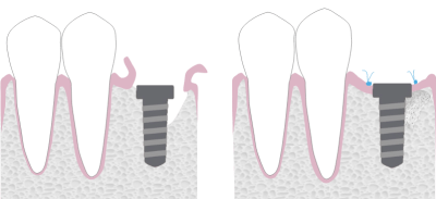 Multiple teeth implants - Hampshire Dentists Pain Free Dentist in Southampton Graphic showing stages of guided bone regeneration