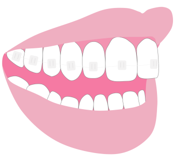 Fixed braces - Hampshire Dentists Pain Free Dentist in Southampton Graphic representation of clear fixed braces on teeth