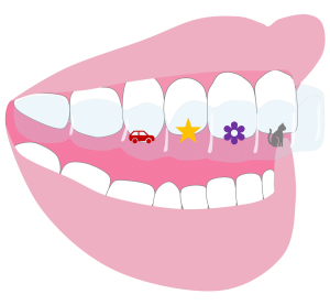 Children’s Braces - Hampshire Dentists Pain Free Dentist in Southampton Graphic representation of Invisalign First aligner on teeth