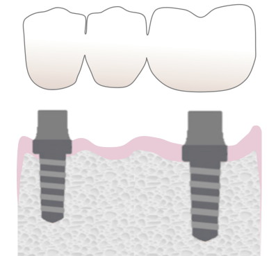 Multiple teeth implants - Hampshire Dentists Pain Free Dentist in Southampton Graphic representing multiple teeth implants