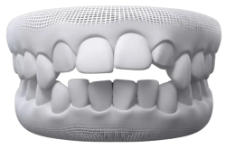 Children’s Braces - Hampshire Dentists Pain Free Dentist in Southampton A 3D model of teeth illustrating an example of teeth showcasing an open bite condition.