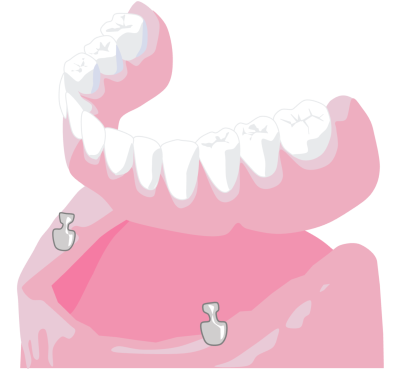 Graphic representation of implant stabilised denture for lower teeth 