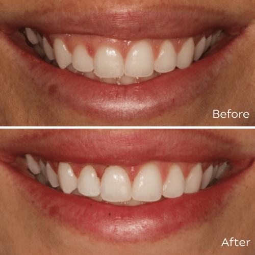 Gum Contouring - Hampshire Dentists Pain Free Dentist in Southampton Gum contouring before and after at Hampshire Dentists, Southampton