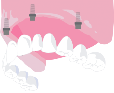 Full mouth implants (All on 4) - Hampshire Dentists Pain Free Dentist in Southampton Graphic representation of all on 4 implant/ full mouth implants to replace all upper teeth
